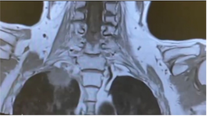 A robotic-assisted Pancoast tumour resection | MMCTS